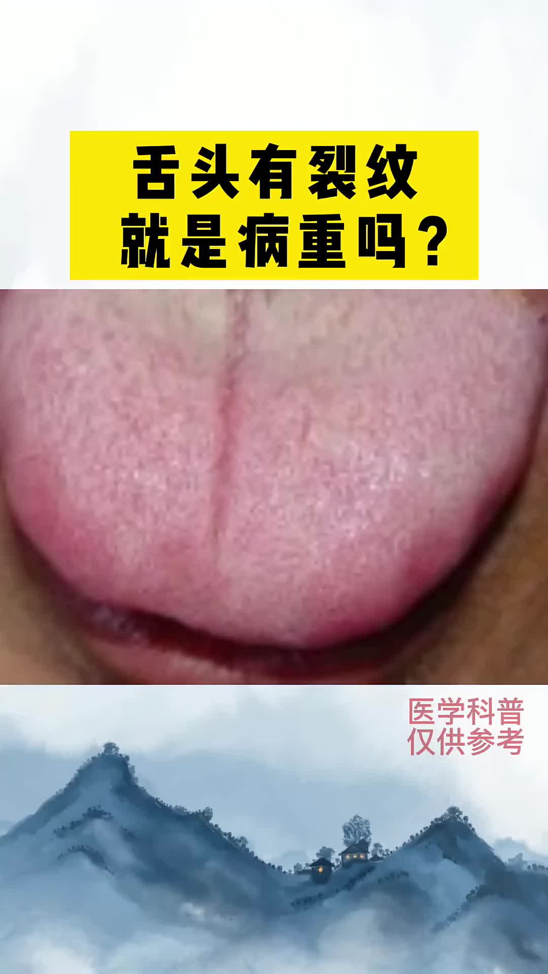 00019 舌头有裂纹，就是有病吗？