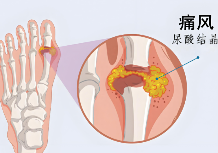 痛风会引起高血压吗 详述痛风与高血压的关系