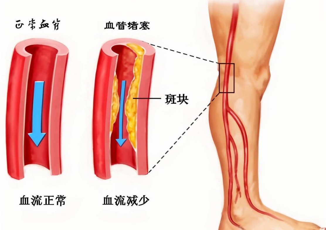 腿部血管堵塞的原因及危害