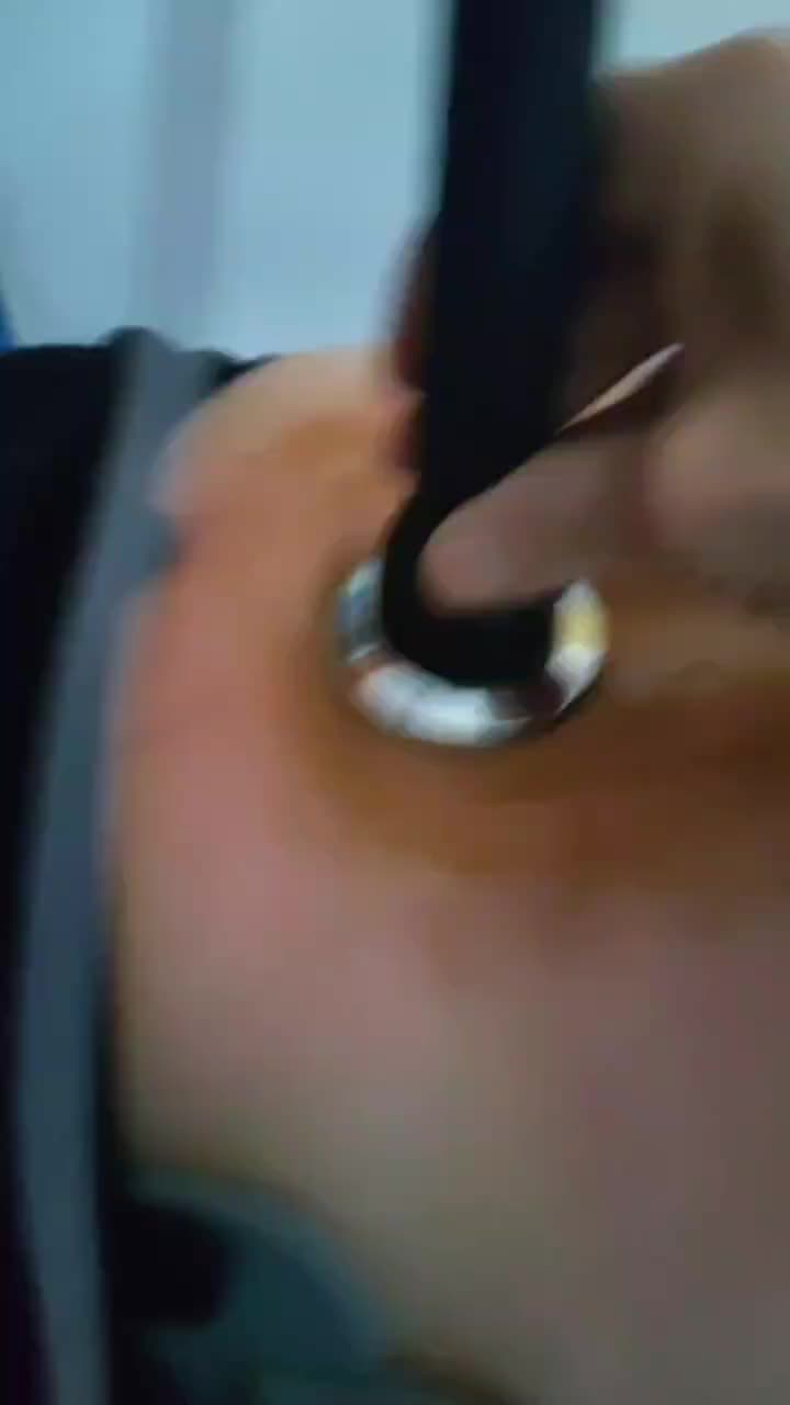 腰间盘突出治疗中