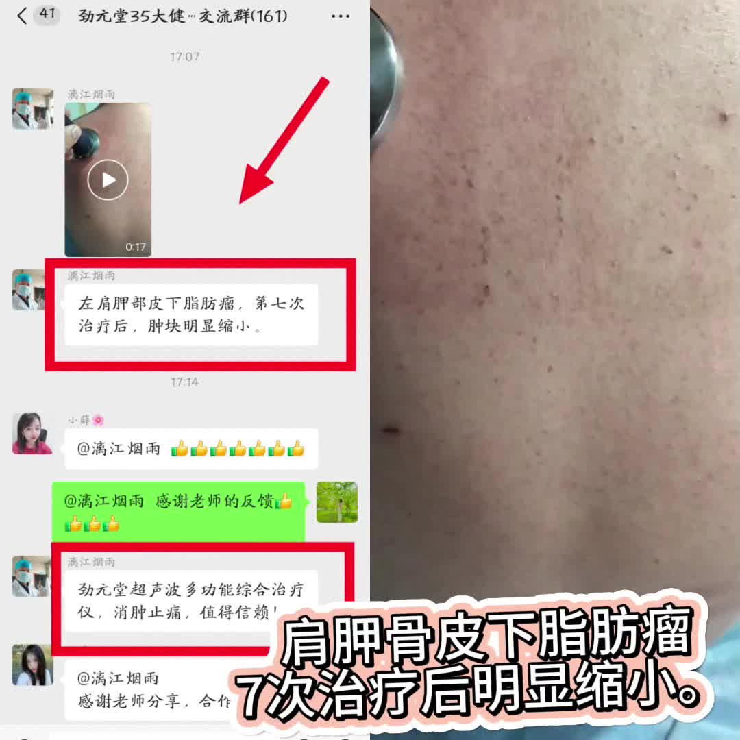 肩胛骨皮下脂肪瘤